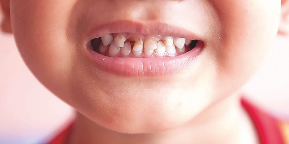 SALUD. Las caries son prevenibles en gran medida y pueden tratarse en sus etapas iniciales.