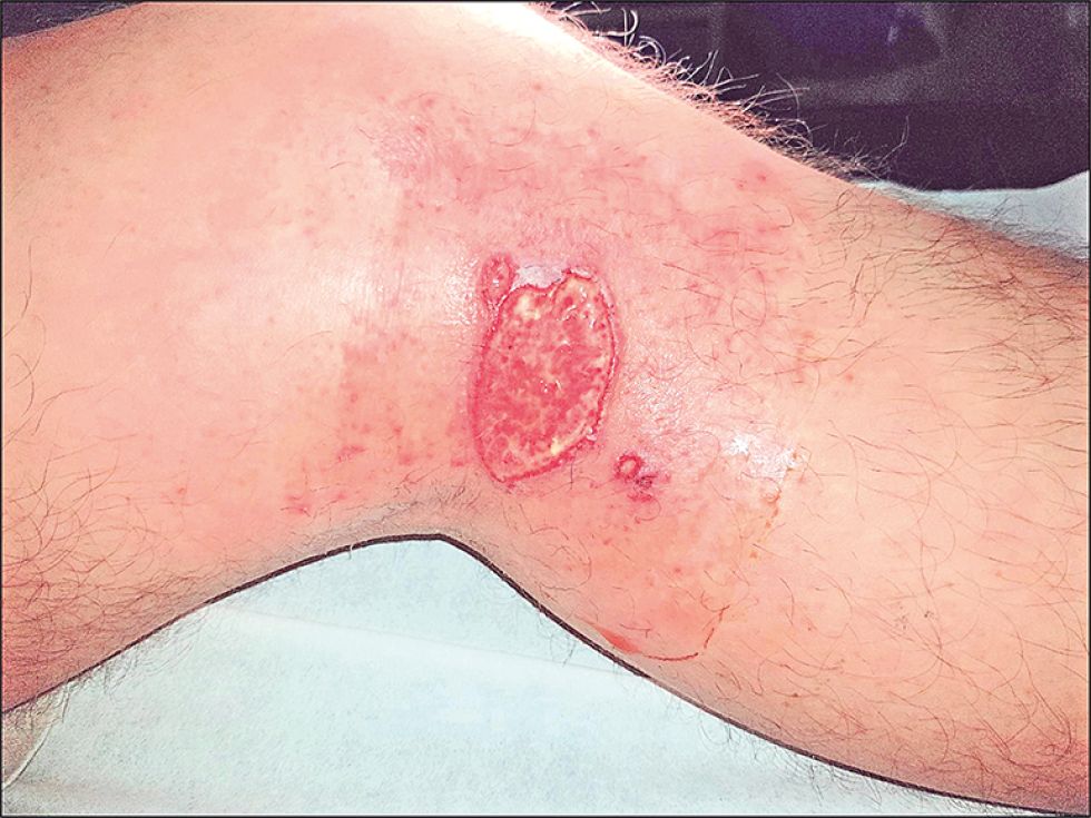 LESIONES. Las heridas causadas por la leishmaniasis son, muchas veces, irreversibles.