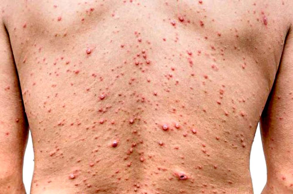 ENFERMEDAD. Una persona con síntomas de la viruela símica, también conocida como mpox.