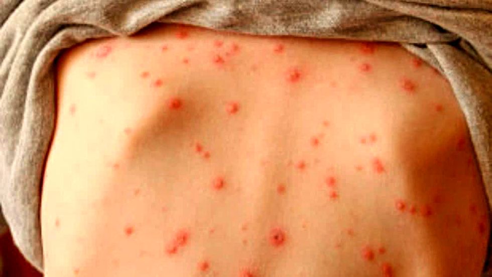 SARAMPIÓN. Santa Cruz refuerza la vigilancia epidemiológica para evitar más brotes.
